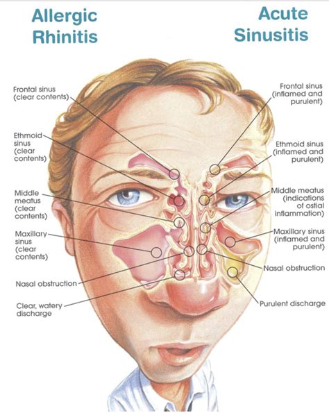 Purulent Nasal Drainage