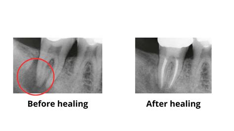 Root Canal Infection Xray A Comprehensive Guide Through Root Canal