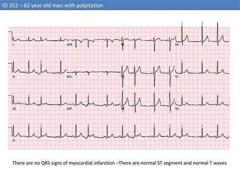 ID 352 –Sinus rhythm With premature atrial complex | PPT
