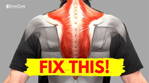 How to Fix Muscle Knots in Your Neck & Shoulder in 30 SECONDS | SpineCare