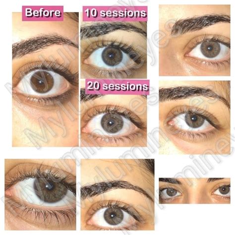 Image result for Eye Color Surgery