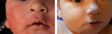 Rash & Eczema Oil for Kids (100ml) – Oleum Cottage