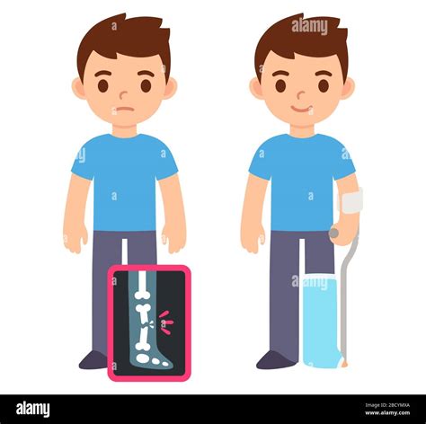 Cute cartoon boy with broken leg on x-ray and recovering with cast and ...