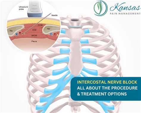 Intercostal Nerve Block: Procedure & Treatment Options