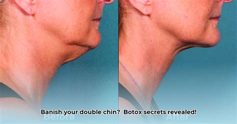 Image result for Chin Botox