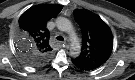 Fluid Around Lung Ct Scan