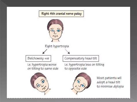 3rd, 4th, & 6th cranial nerve palsy | PPTX