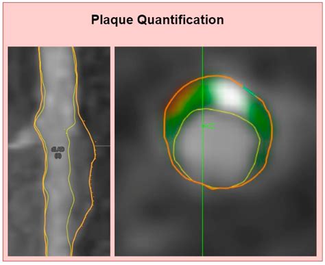 Association of Low-Attenuation Plaque with Impaired Glucose Tolerance ...