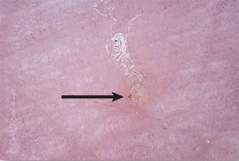 Scabies: a clinical update - Iyengar - 2024 - Medical Journal of ...