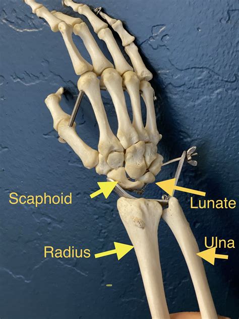Arm Wrist Bone Pain at Linda Platt blog
