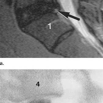 Image result for Lumbar Discogram