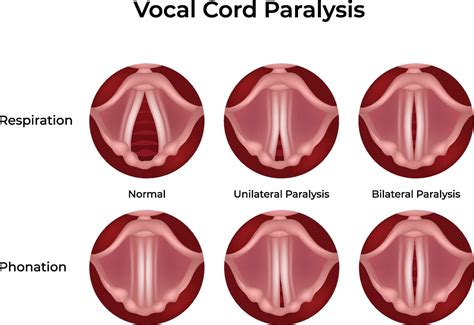 Vocal Cord Paralysis Normal vs Affected Design Illustration 56049559 Vector Art at Vecteezy