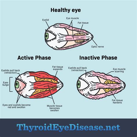 2 Phases of Thyroid Eye Disease: Symptoms and Treatments