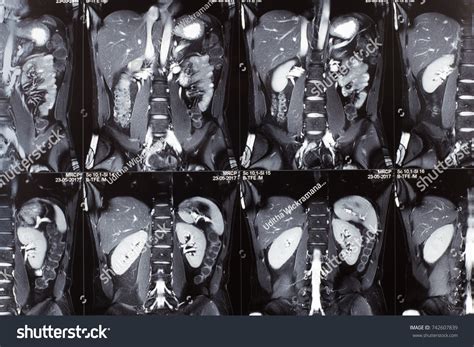 What Is A Mri With Mrcp at Rebecca Skinner blog