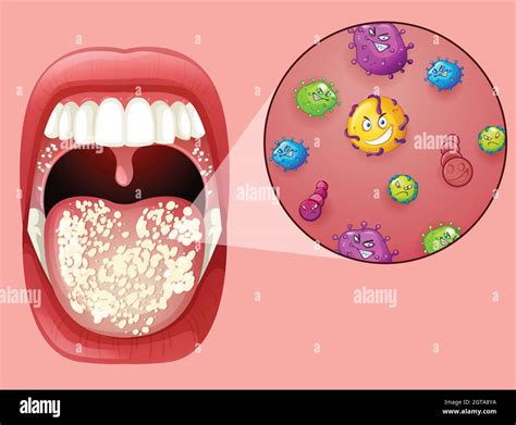 Oral Thrush Contagious