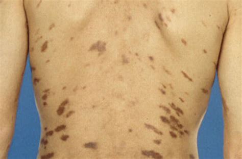 Kuvatulokset haulle castleman s disease specialist