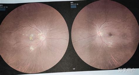 激光手术治疗近视眼会有副作用吗？一文解答你对激光手术的疑惑！_角膜
