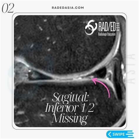 MENISCUS TEAR MRI KNEE: MISSING MENISCI WHAT TO LOOK FOR - Radedasia
