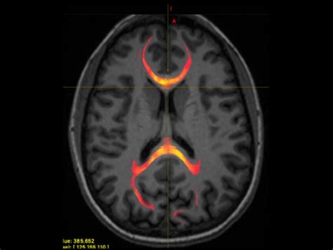 Image result for Contralateral Brain Injury