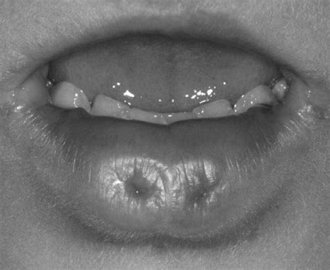 Van der Woude Syndrome and Lower Lip Pits Treatment - Journal of Oral ...