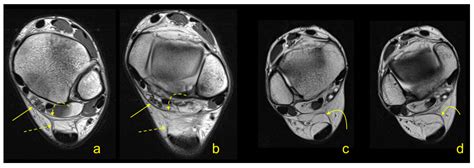 The Flexor Retinaculum Connects the Surrounding Structures into the Medial Ankle Complex