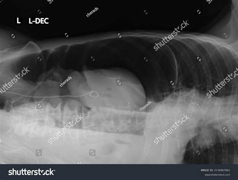 10 Left De Cubitus Images, Stock Photos & Vectors | Shutterstock