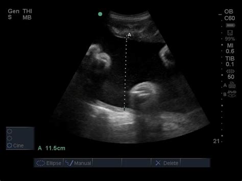 Amniotic Fluid | BCPoCUS