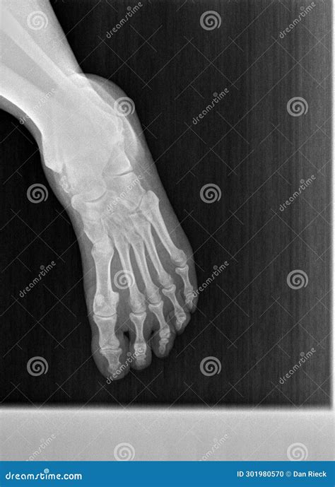 Normal Foot 的图像结果