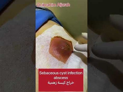 Image result for Back Full of Exploding Cysts