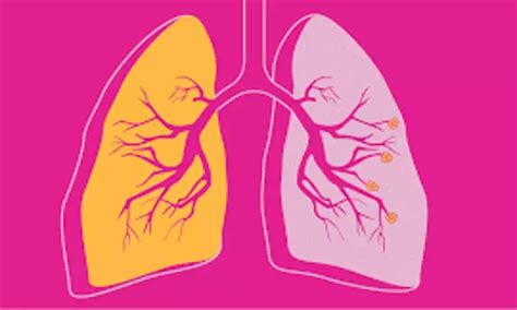 SWEmean of Quadriceps a Potential Index of evaluation of clinical ...