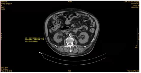 多排螺旋CT对乏脂性肾血管平滑肌脂肪瘤的诊断价值