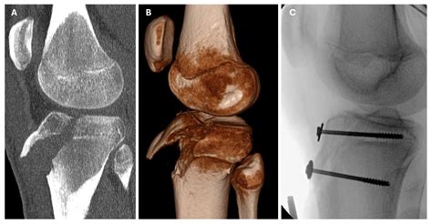 Association of Elevated Body Mass Index with Tibial Tuberosity Avulsion Fractures in Pediatric ...