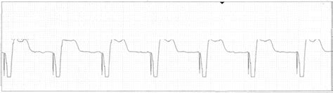 Image result for Synchronized Cardioversion EKG Strips Practice