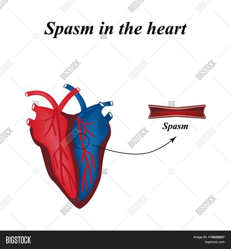 Spasm Arteries Heart Vector & Photo (Free Trial) | Bigstock