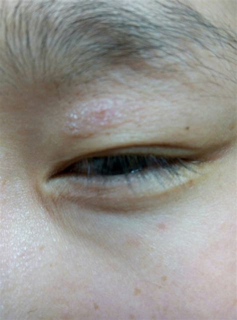 左眼眼皮上长了东西，有点皮屑，有点发红，微肿，不痒不痛，过了一周了没有蔓延现象。这是什么，是癣吗，_百度知道