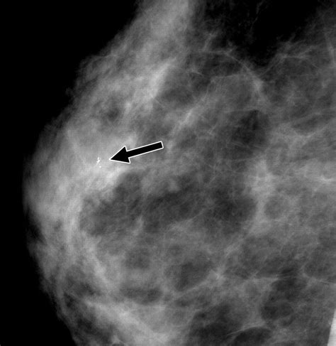 The Many Faces of Fat Necrosis in the Breast | AJR