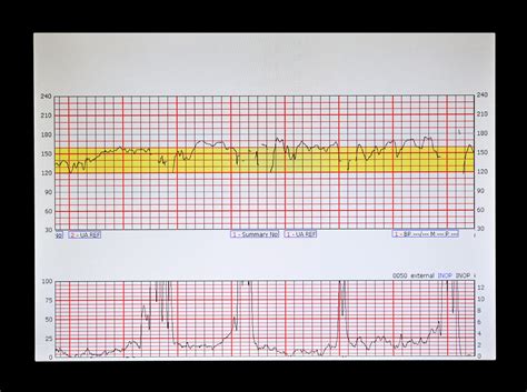 Normal Fetal Heart Tracing