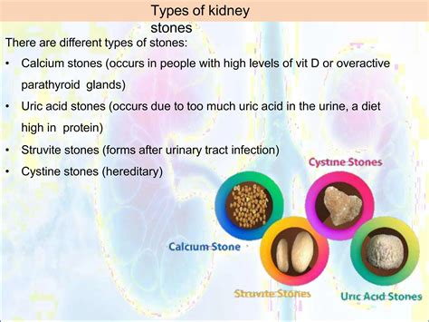 kidney stones types, complications, symptoms | PPTX
