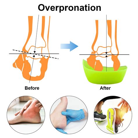 Overpronation Of Foot Overpronation, Flat Feet And Fallen Arches