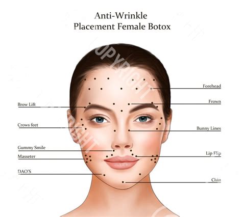 Image result for Botox Forehead Injection Sites Tutorial