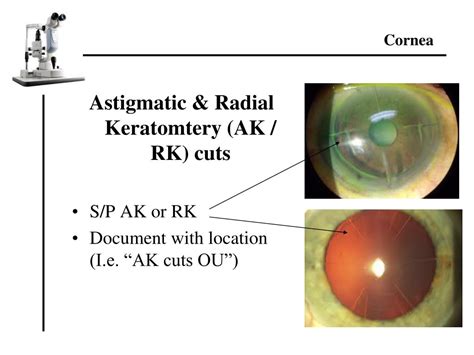 Image result for Slit Lamp Exam Tutorial