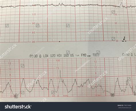 437 Ecg Baby Images, Stock Photos & Vectors | Shutterstock