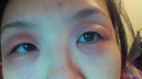 从5天前开始，眼睛肿痛，眼皮发红，刚开始是左下眼皮红肿疼痛，眼皮里面还有白色的小痘痘，现在白色小点_百度知道