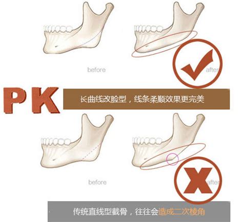 上海俞良钢磨骨多少钱 - 下颌角整形 - 炫美网