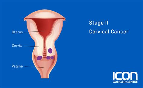 Cervical Cancer | Icon Cancer Centre Indonesia
