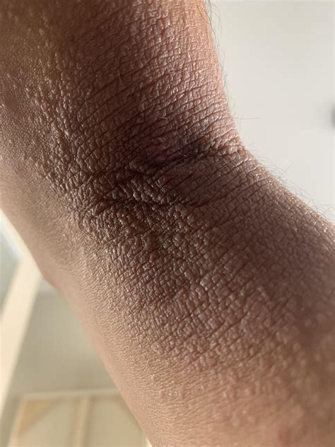 Image result for Exploding Elbow Pimple