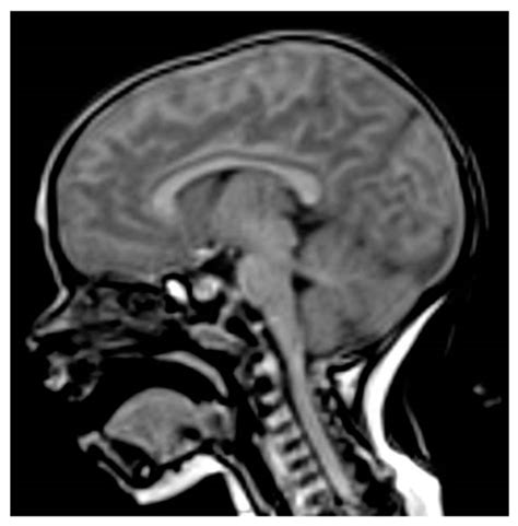 Enlarged Pituitary Gland Mri