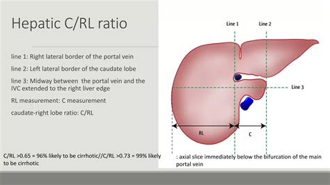 Imaging of portal hypertension | PPTX