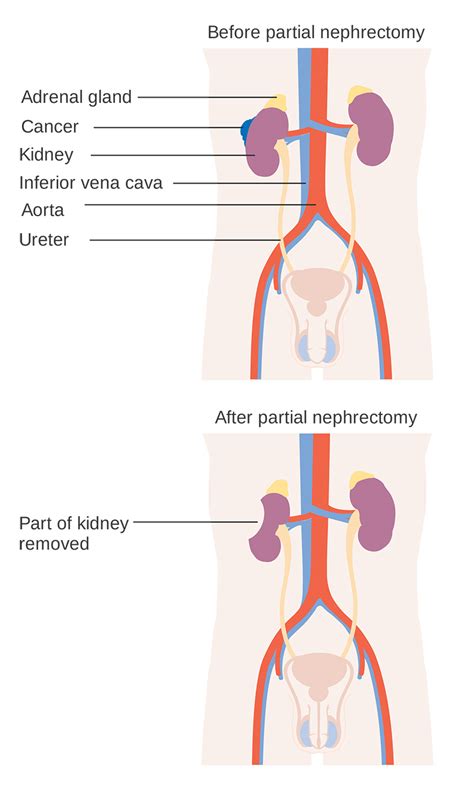 Image result for Nephrectomy Procedure