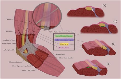 Compression of the Ulnar Nerve by the Arcade of Struthers: Look and You Shall Find - Shady ...